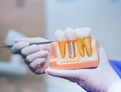 Dental Implants