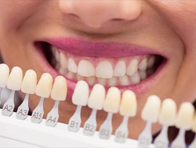Porcelain Veneers