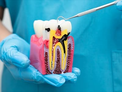 Root Canal Treatment